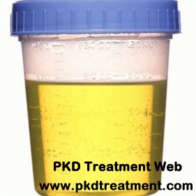 Could A Cyst in the Kidney Cause Protein in Urine
