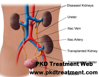What are the Life Expectancy for PKD Patients Who Want to Have Kidney Transplant