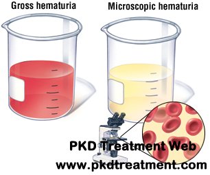 How Come Polycystic Kidney Make Hematuria