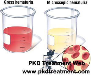 How does Kidney Cyst Cause Hematuria