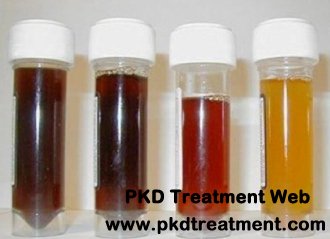 Gross Hematuria and Polycystic Kidney Disease: Causes and Treatment