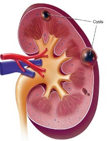 What is Cortical Cyst of Kidney