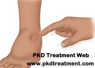Do the Feet Swell When Kidneys Fail