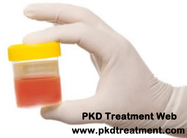 Why is Hematuria Common With Polycystic Kidney Disease  