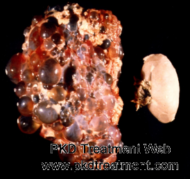 How to Survive from Polycystic Kidney Disease