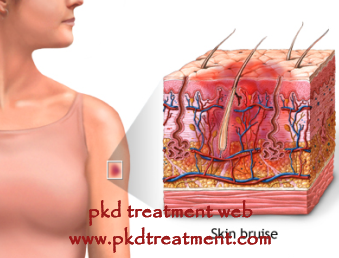 Why Do PKD Stage 3 Patients Bruise Easily