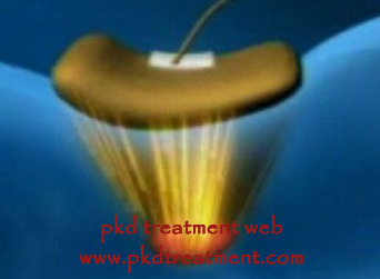 Causes And Treatment For Polycystic Kidney Disease (PKD)
