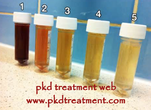 How Long Does the Blood in Urine Take To Stop After 6 cm Kidney Cyst Ruptures