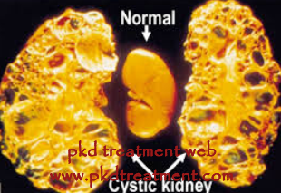 How to Treat PKD Naturally 