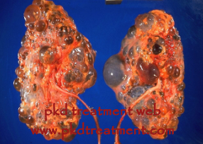 How Severe Is The Size of 2.9*2.8 cm Kidney Cyst 
