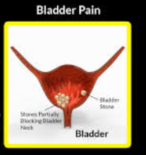 Can You Get Bladder Pain with PKD 