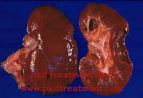 6 cm Kidney Cyst Can Cause Pain on Patients 