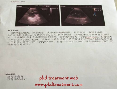 For his son, the blood pressure got reduced very effectively, kidney cysts 6.5 cm were shrunk to 2.2 cm. thus, it is very good for patient with PKD to get treated with Chinese medicine treatment.  Thus, we can see that the effects of son is much better than dad, and dad said: only less than 3 days, my treatment did not catch up with son.  Chinese medicine can shrunk kidney cysts well prevent secreting cyst fluids and enhancing permeability of cyst walls to let cyst fluids flow out. Kidney cyst can be controlled from the root very effectively. Kidney damage can be avoided further for patients.