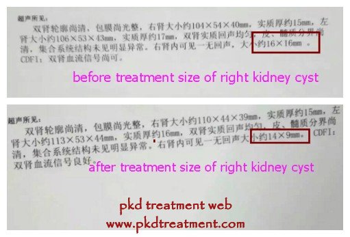 How to Shrink Kidney Cyst to Prevent Kidney Damage 